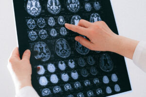 MRI and PET research study recruiting participants over 60 - image of hand pointing at human brain radiographs